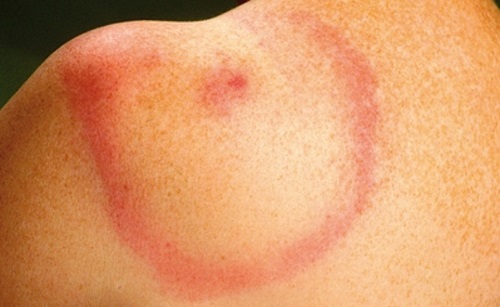 Na de beet: het eerste stadium van de ziekte van Lyme, de kenmerkende rode ring van de Erythema migrans. Overigens treedt die niet altijd op na een beet.